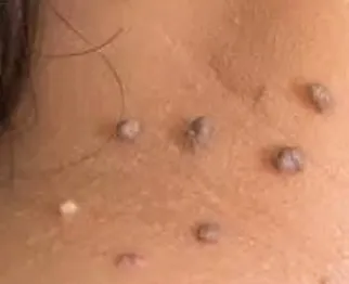 1 Acrochordons.ledegoteur.fr