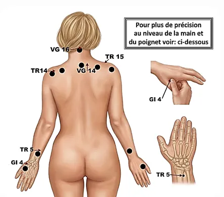 Différents points à stimuler en digiponcture dans le cas d'un torticolis .ledegoteur.fr